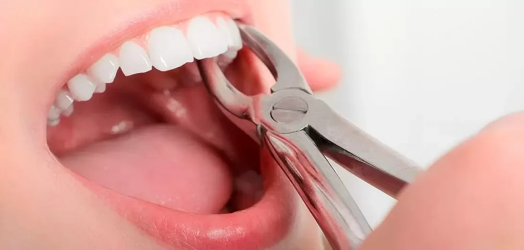 Diş Çekimi Sonrası İyileşme Süreci